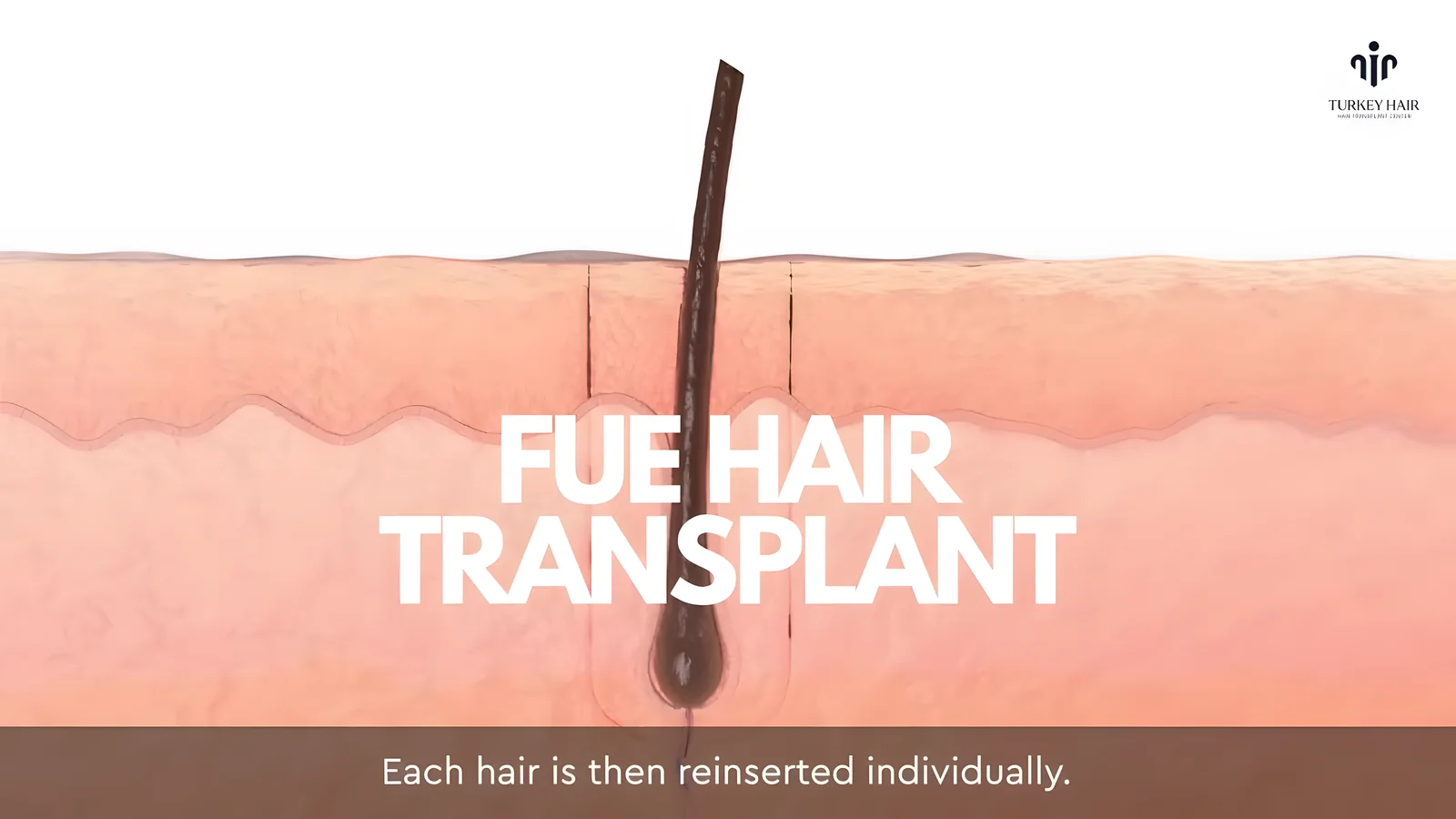 FUE HAIR TRANSPLANT | #turkeyhairtransplant
