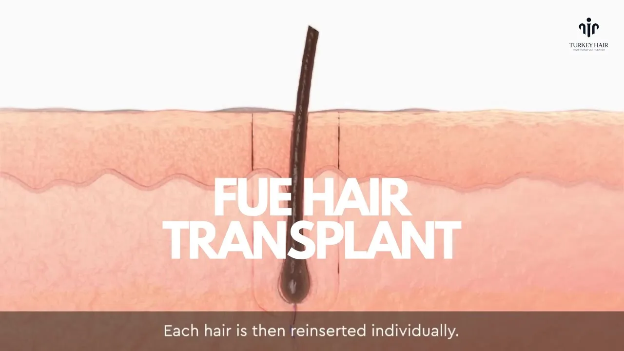 What Is FUE Hair Transplant and Why It Is Popular Worldwide
