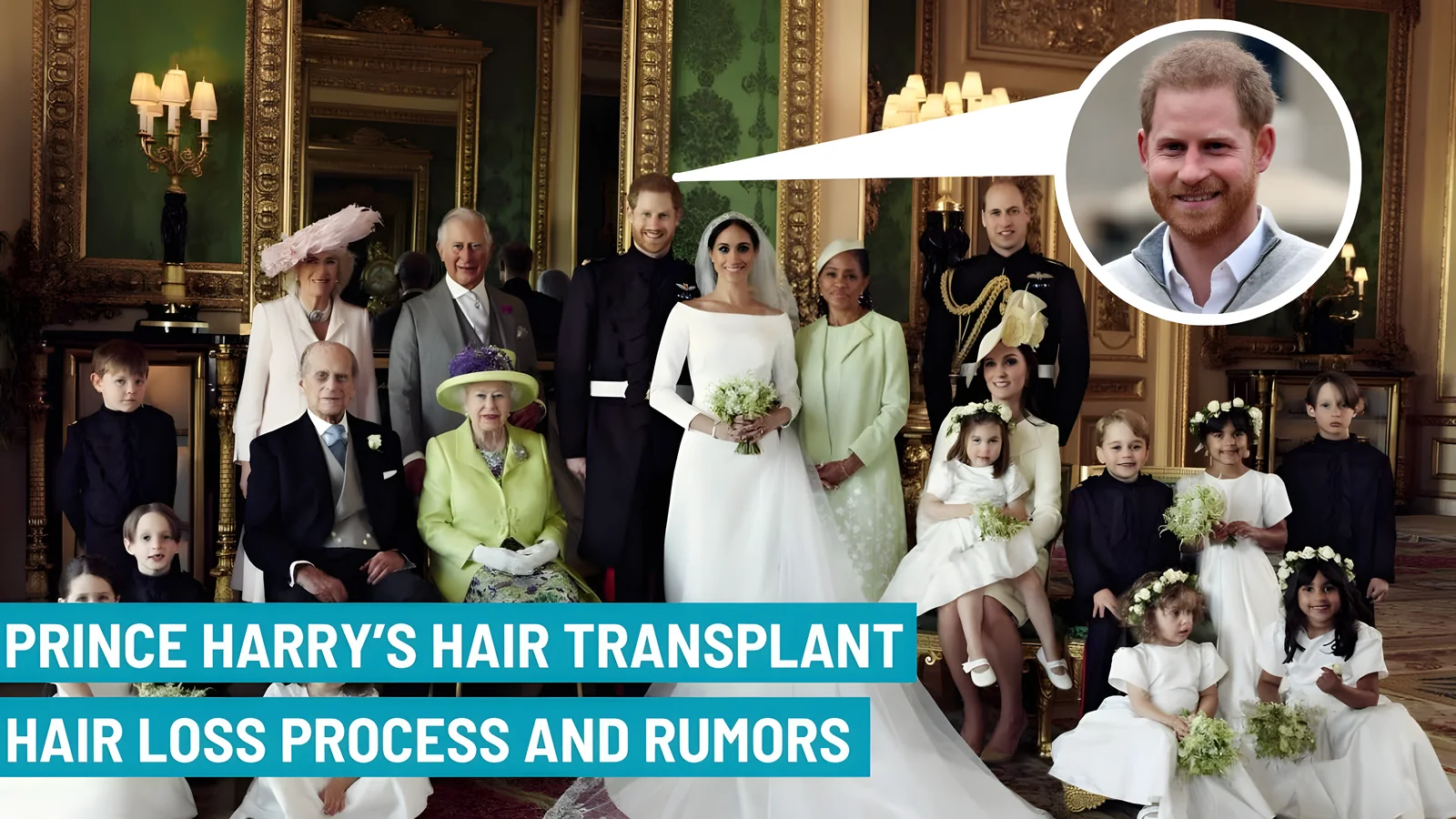 PRINCE HARRY'S HAIR TRANSPLANT: HAIR LOSS PROCESS