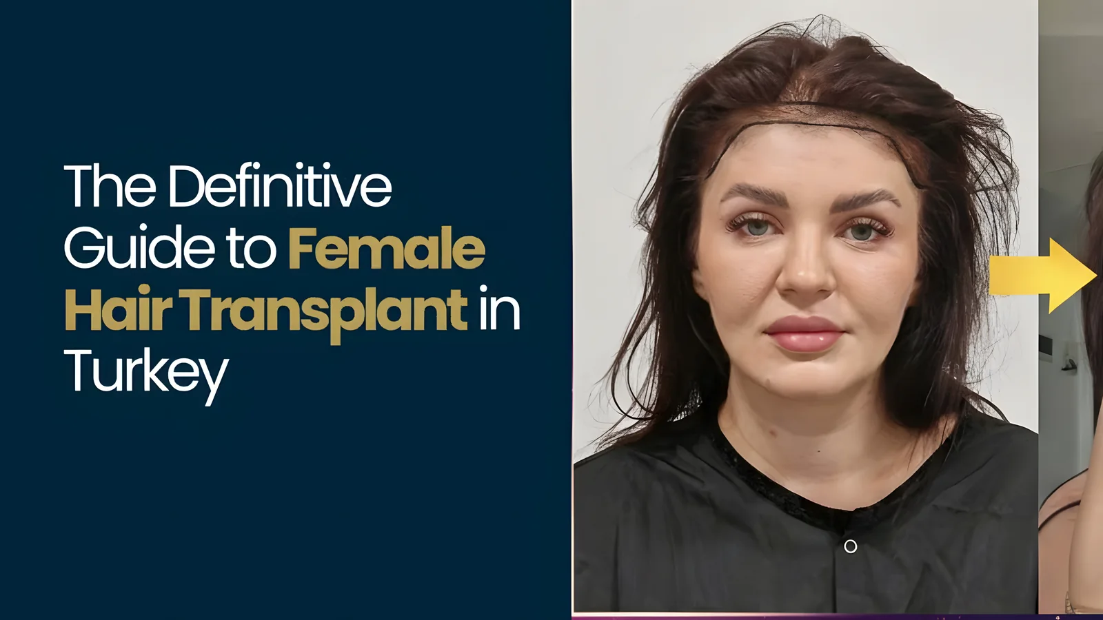 Female Hair Transplant Turkey Cost | Pricing, Techniques & What Affects the Price