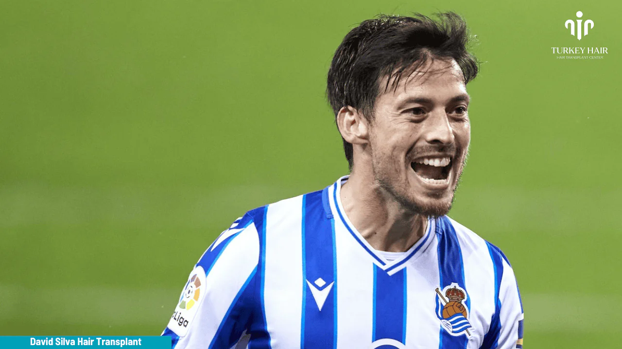 How Long Do Hair Transplants Last?