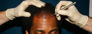 Afro Hair transplant cost