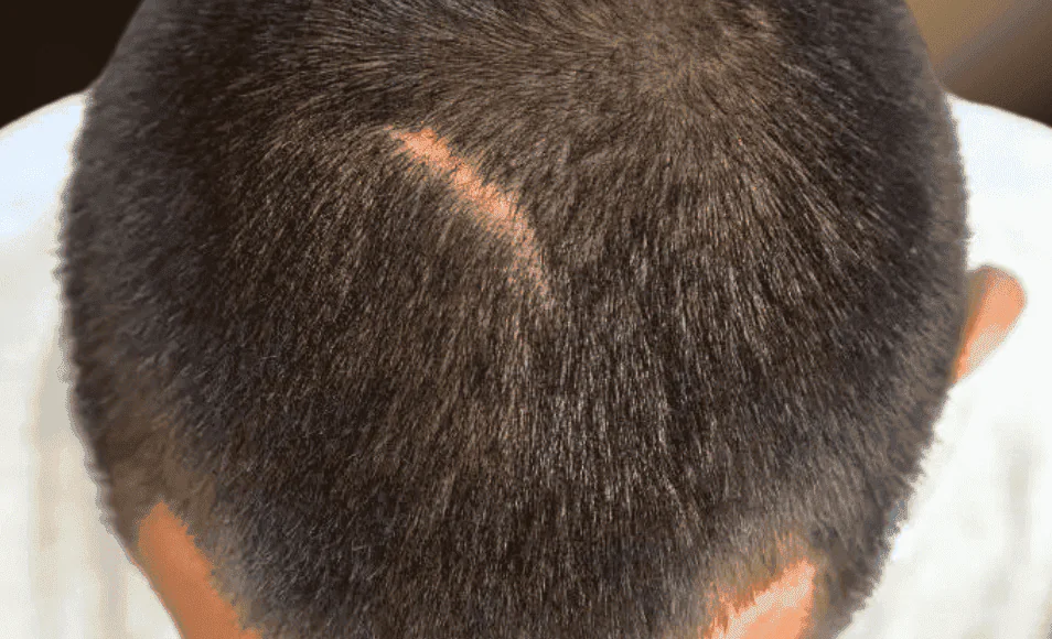 Fix Scar Hair Transplant Fix Scar Hair Transplant