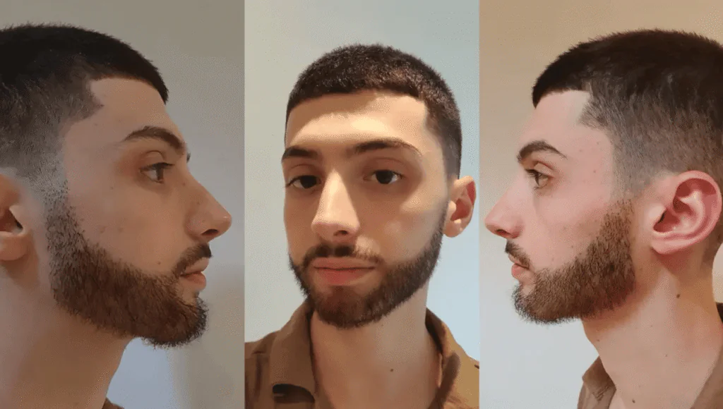 Beard-Transplant-After Beard Transplant Before And After