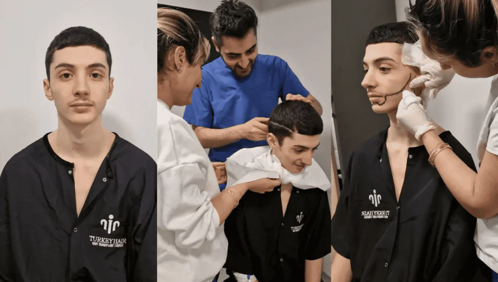 Beard Hair Transplant Before And After​