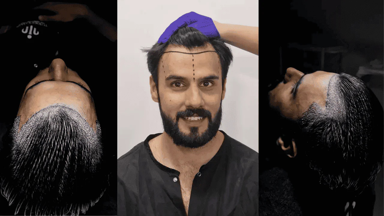 dhi-hair-transplant-surgery-1280x720 DHI Hair Transplant