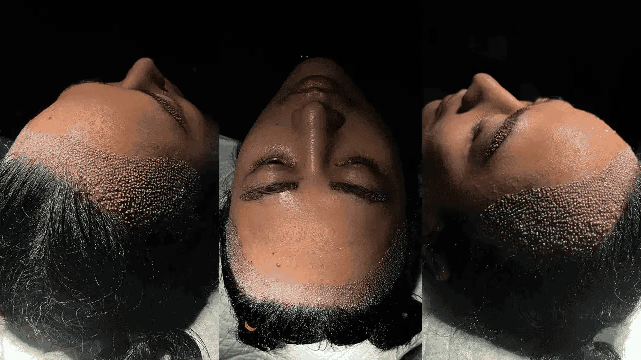 eyebrow-transplant-operation-1280x720 hair transplant for eyebrows