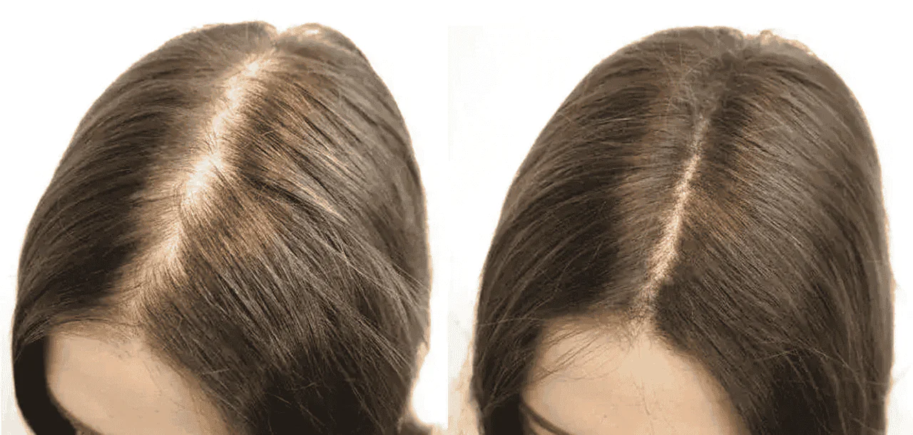 Hair Transplant For Women Hair Transplant For Women