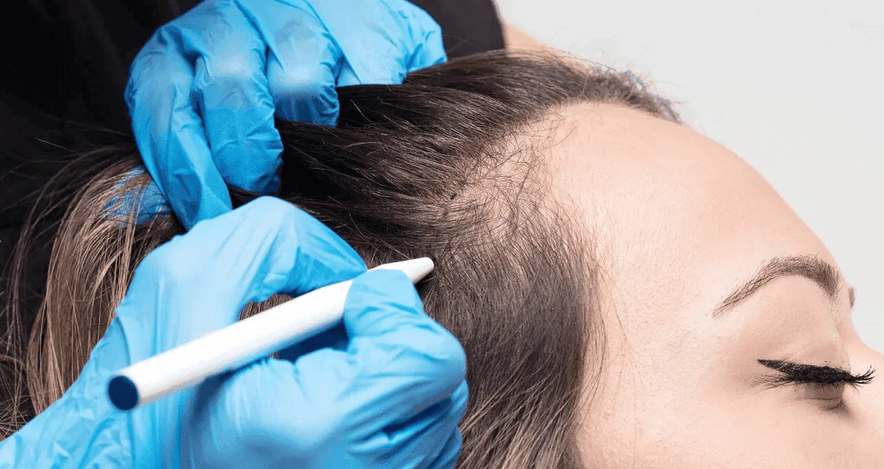 women's hair transplant turkey