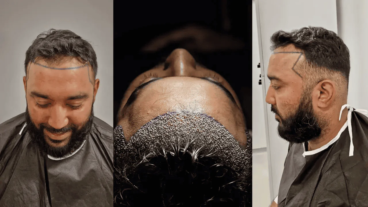 no-shave-hair-transplanr-02 no shave hair transplant turkey