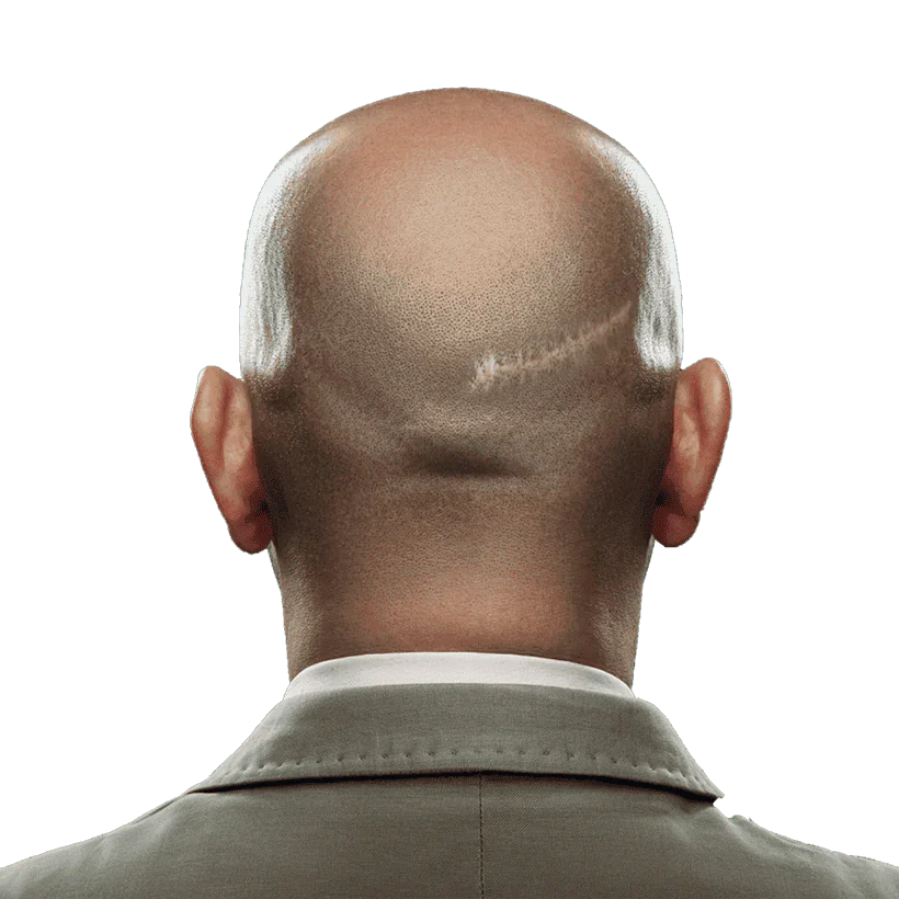 celebrity hair transplant scar celebrity hair transplant scar