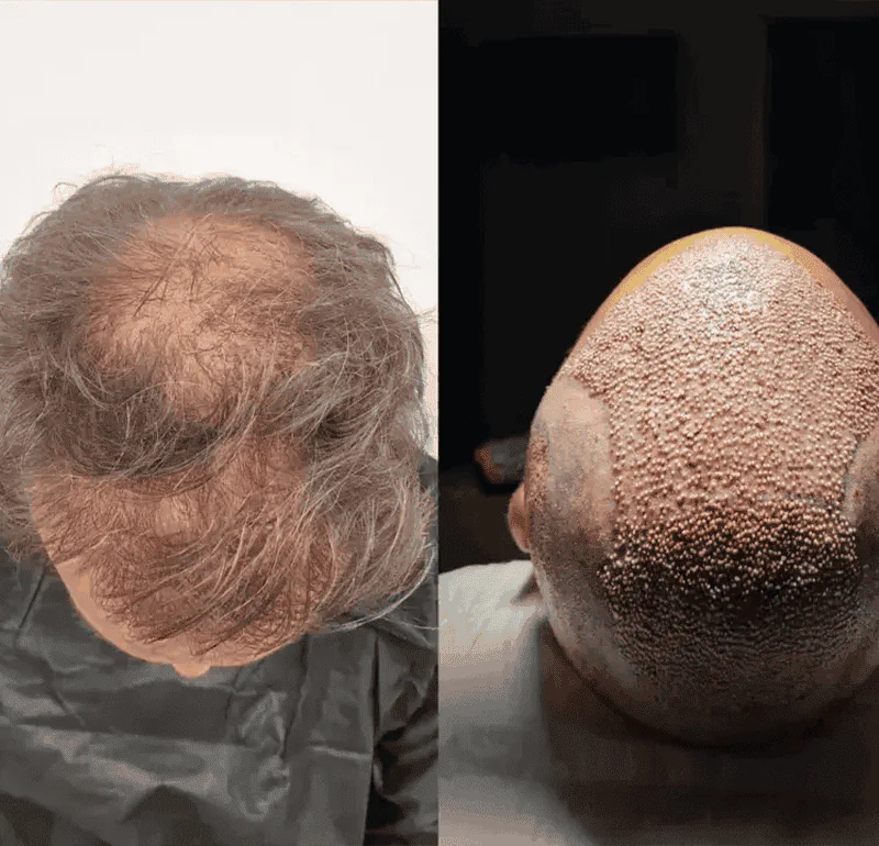 Turkey Hair Center world-record Turkey Hair Center world-record
