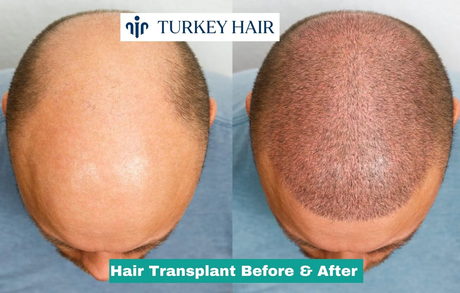 Hair Transplant Scar Before And After