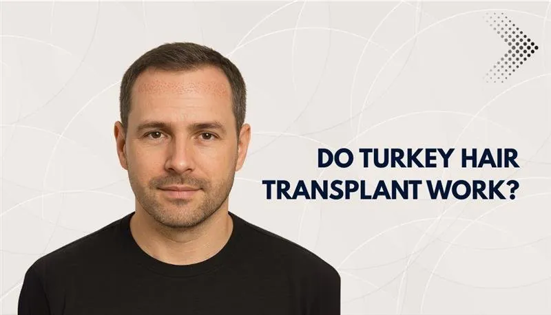 Turkey Hair Transplants Work