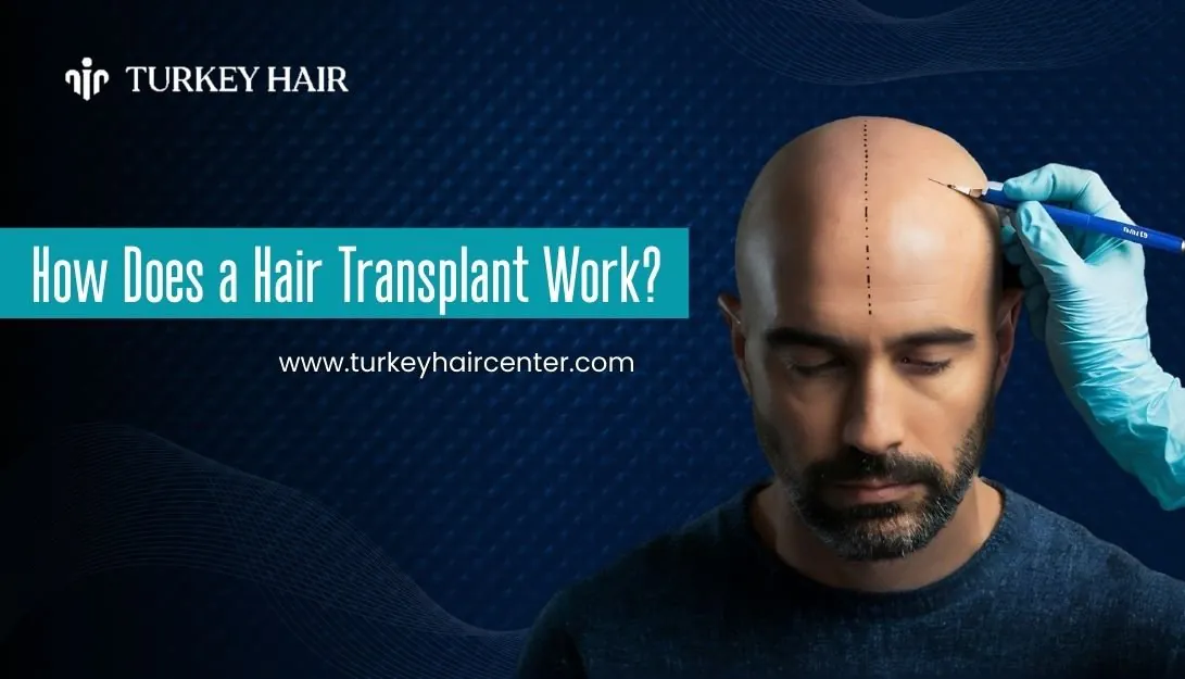 Hair Transplant Work