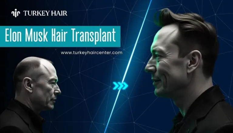 elon musk hair transplant