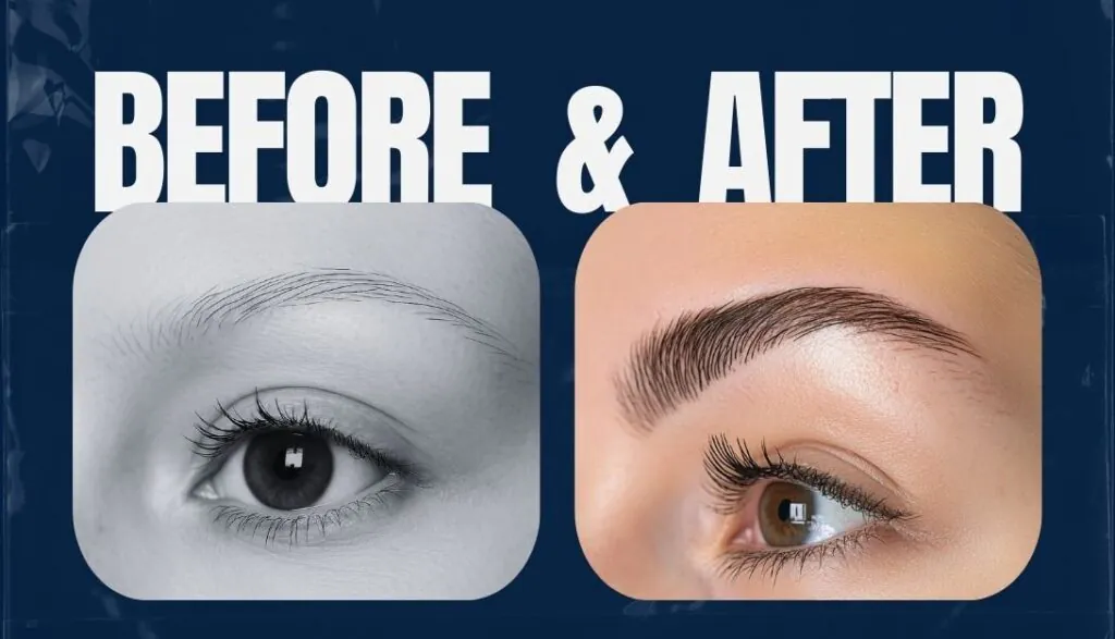 Eyebrow Hair Transplant​ Before & After