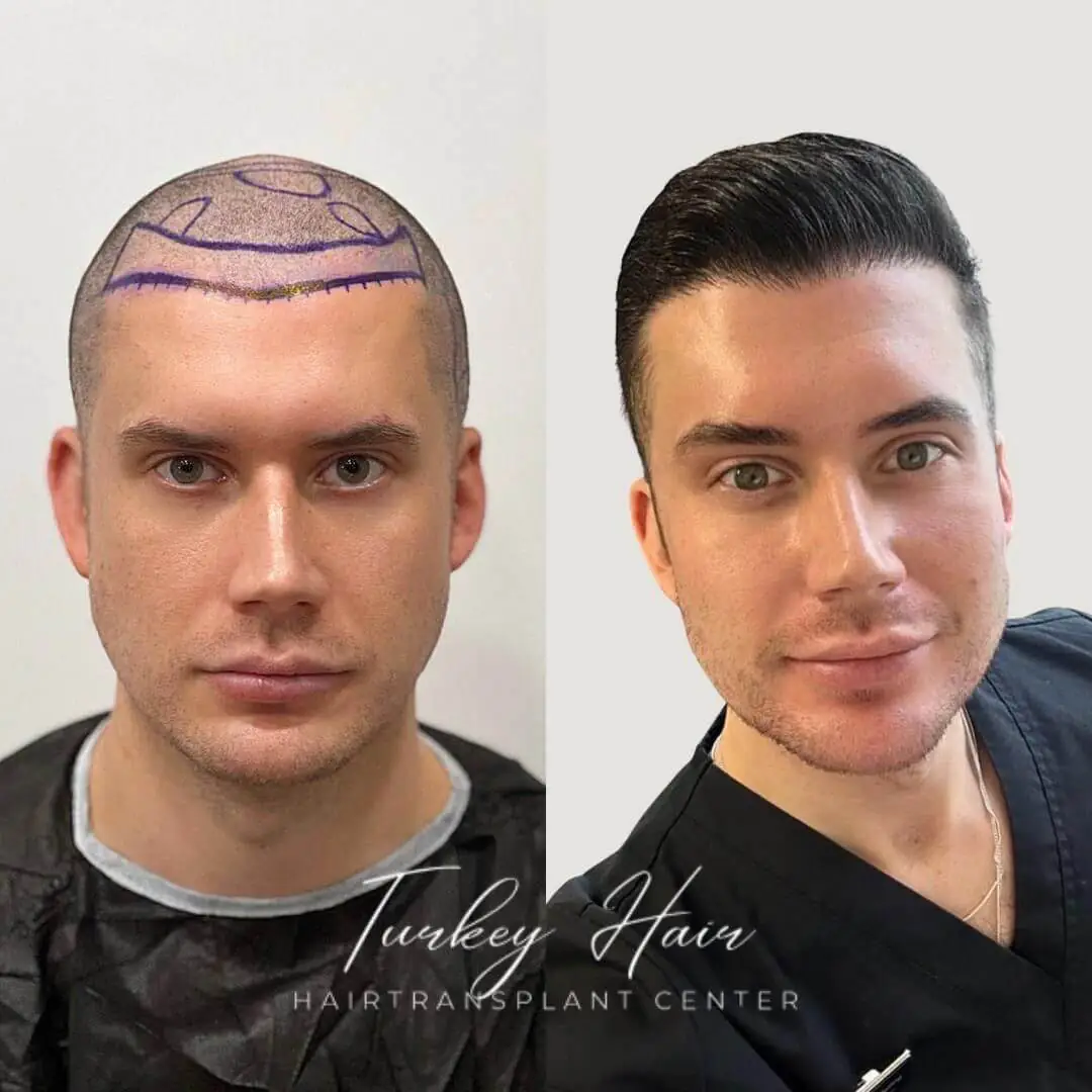 1000 Grafts Hair Transplant Before And After