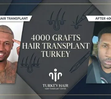 4000 Grafts Hair Transplant Turkey   Cost And Procedure