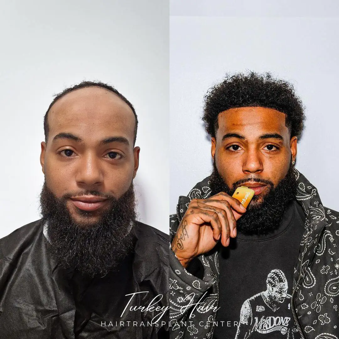 5000 Grafts Hair Transplant Turkey - Cost - Before And After 4 5000 Grafts Hair Transplant Before And After